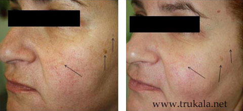 دستگاه پلاژن سه هندپیس Pollogen OxyGeneo - تروکالا