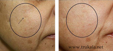 دستگاه پلاژن سه هندپیس Pollogen OxyGeneo - تروکالا