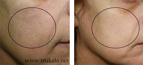 دستگاه پلاژن سه هندپیس Pollogen OxyGeneo - تروکالا