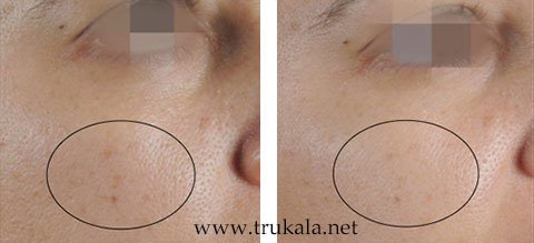 دستگاه پلاژن سه هندپیس Pollogen OxyGeneo - تروکالا