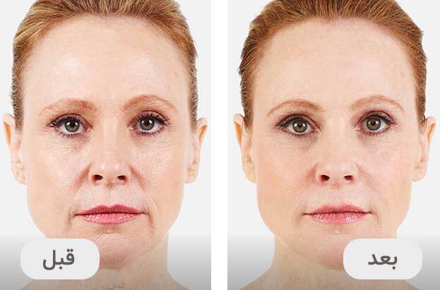 دستگاه میکرونیدلینگ درماپن A6 0