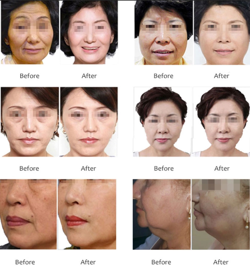 دستگاه هایفو اولترا لیفتینگ پوست صورت و بدن سه کاتریج 7