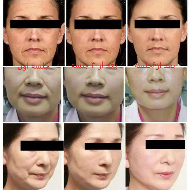 دستگاه هایفو وی مکس