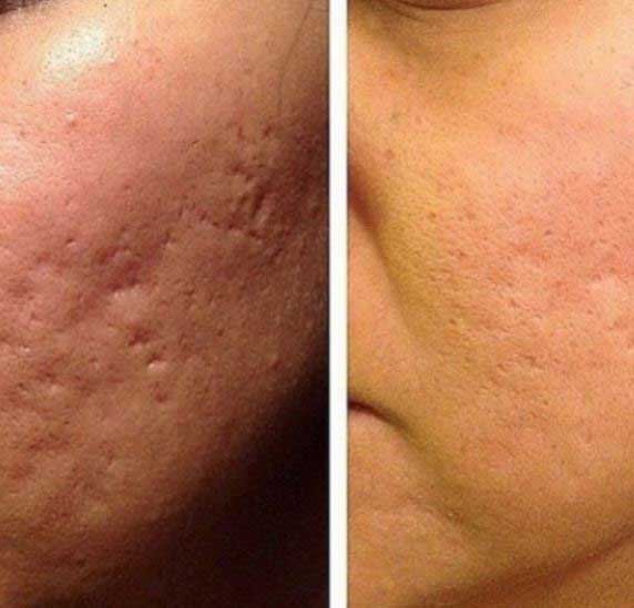 میکرونیدلینگ چیست؟ 1