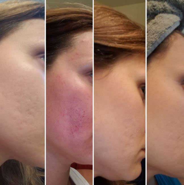 میکرونیدلینگ چیست؟