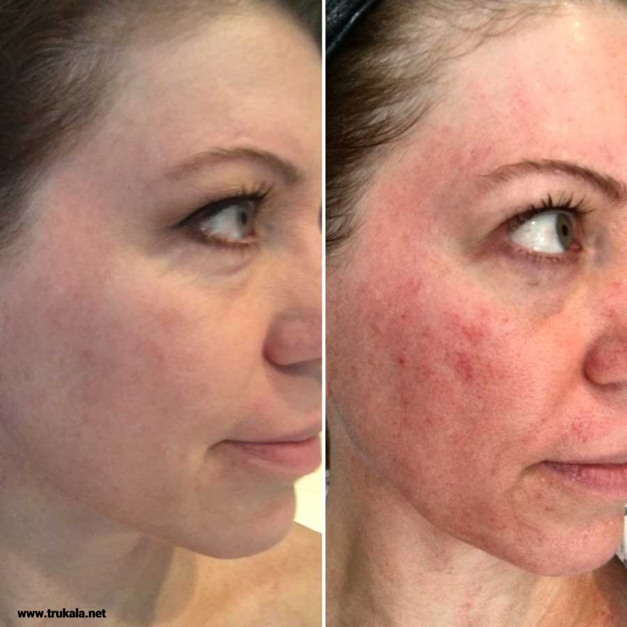 فواید میکرودرم