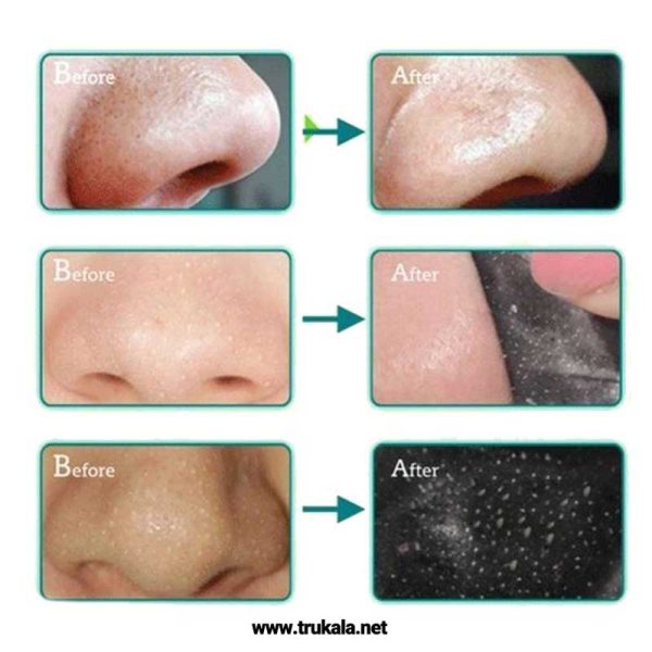 بلک ماسک جوش های سرسیاه بینی