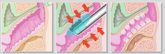 دستگاه هایفو اولترا واژینال