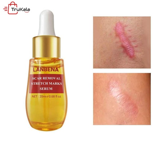 سرم درمانی تی سی ام لانبنا