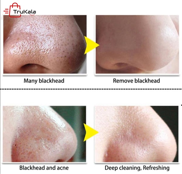 چسب بینی لانبنا