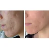 کوکتل لایه برداری و پیلینگ SRS ژنوسیس