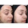 کوکتل لایه برداری و پیلینگ SRS ژنوسیس
