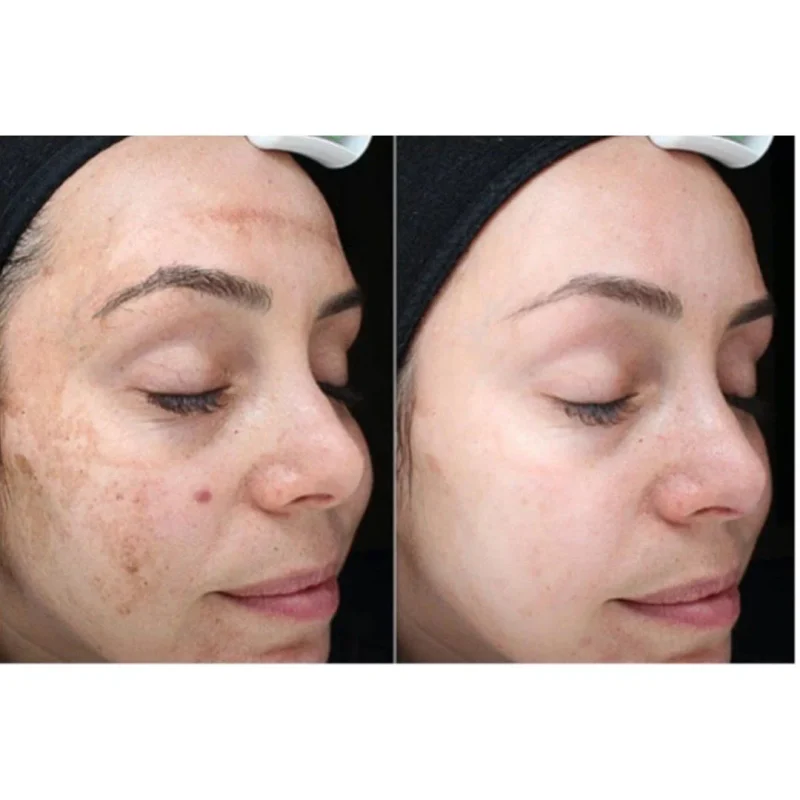 کوکتل لایه برداری و پیلینگ SRS ژنوسیس