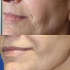کوکتل لایه برداری و پیلینگ SRS ژنوسیس