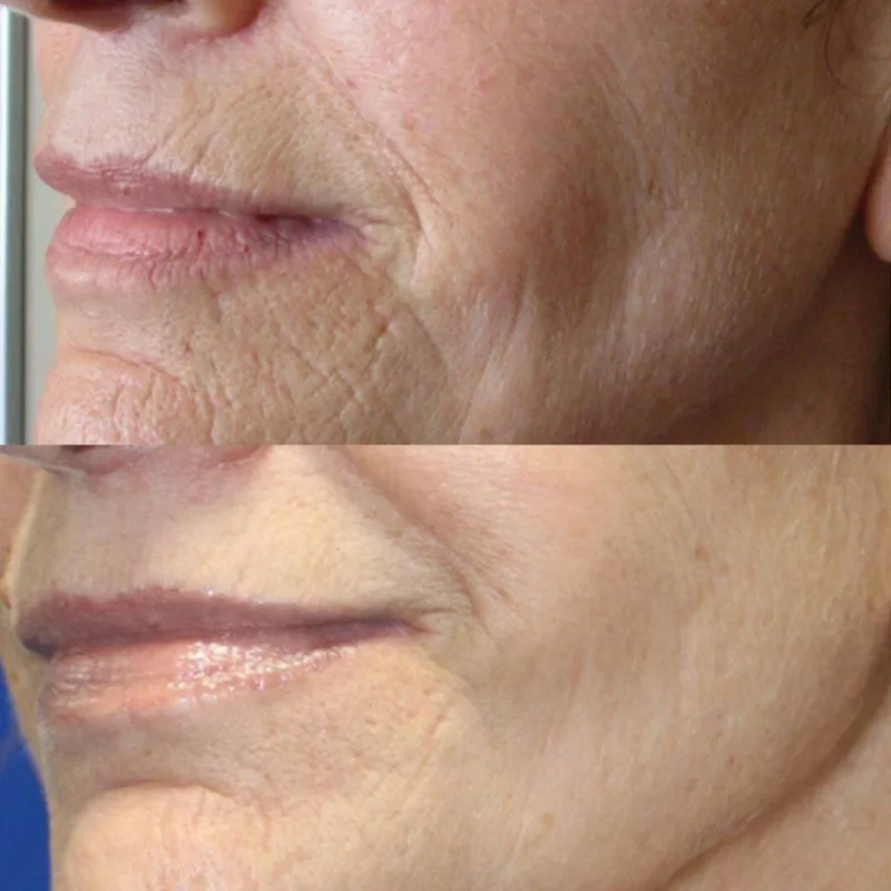 کوکتل لایه برداری و پیلینگ SRS ژنوسیس