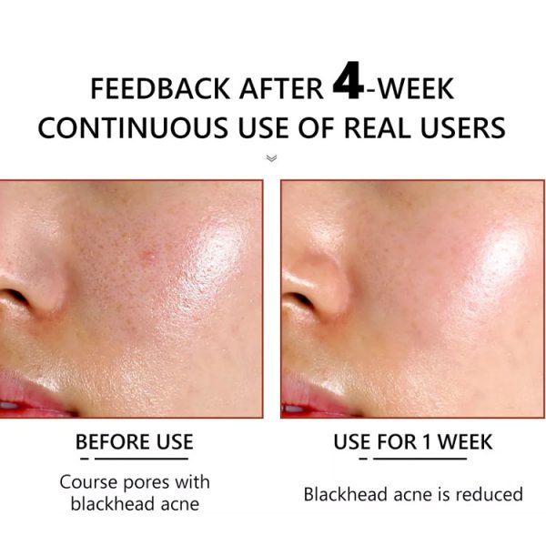 سرم کاهش منافذ چهارده روزه