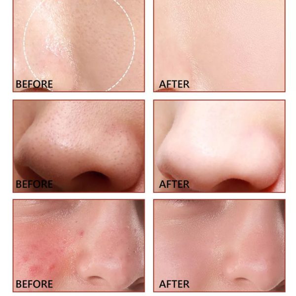 سرم کاهش منافذ چهارده روزه