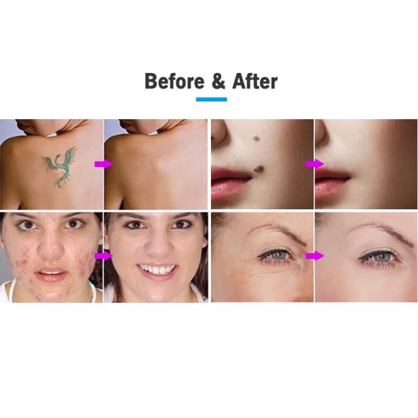 پلاسما فیوژن نیوفیس ایکس پل