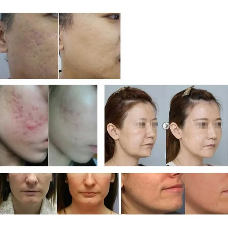 دستگاه هیدروفیشیال 7 کاره لیز