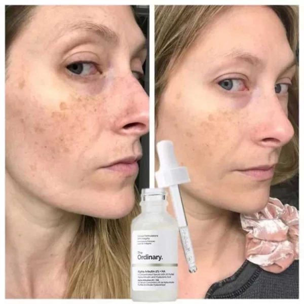 سرم آلفا آربوتین 2% اوردینری