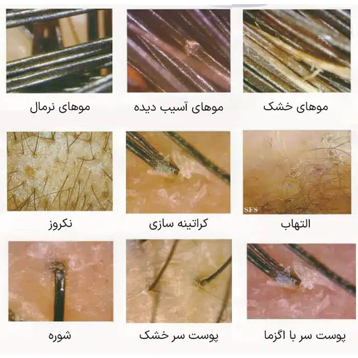 دستگاه آنالیزور دار اسکالپ سر