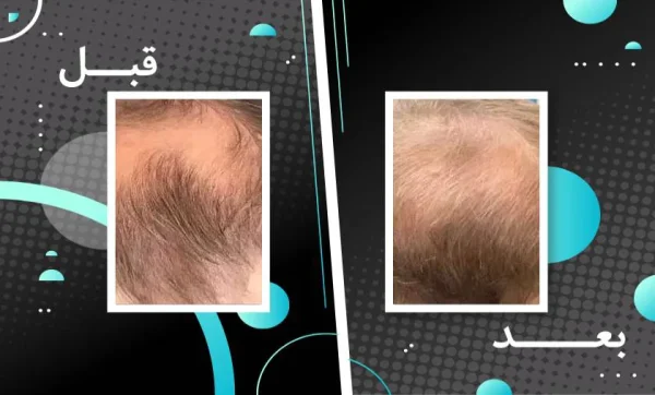 قرص تقویت کننده مو و ناخن فیتو فانر