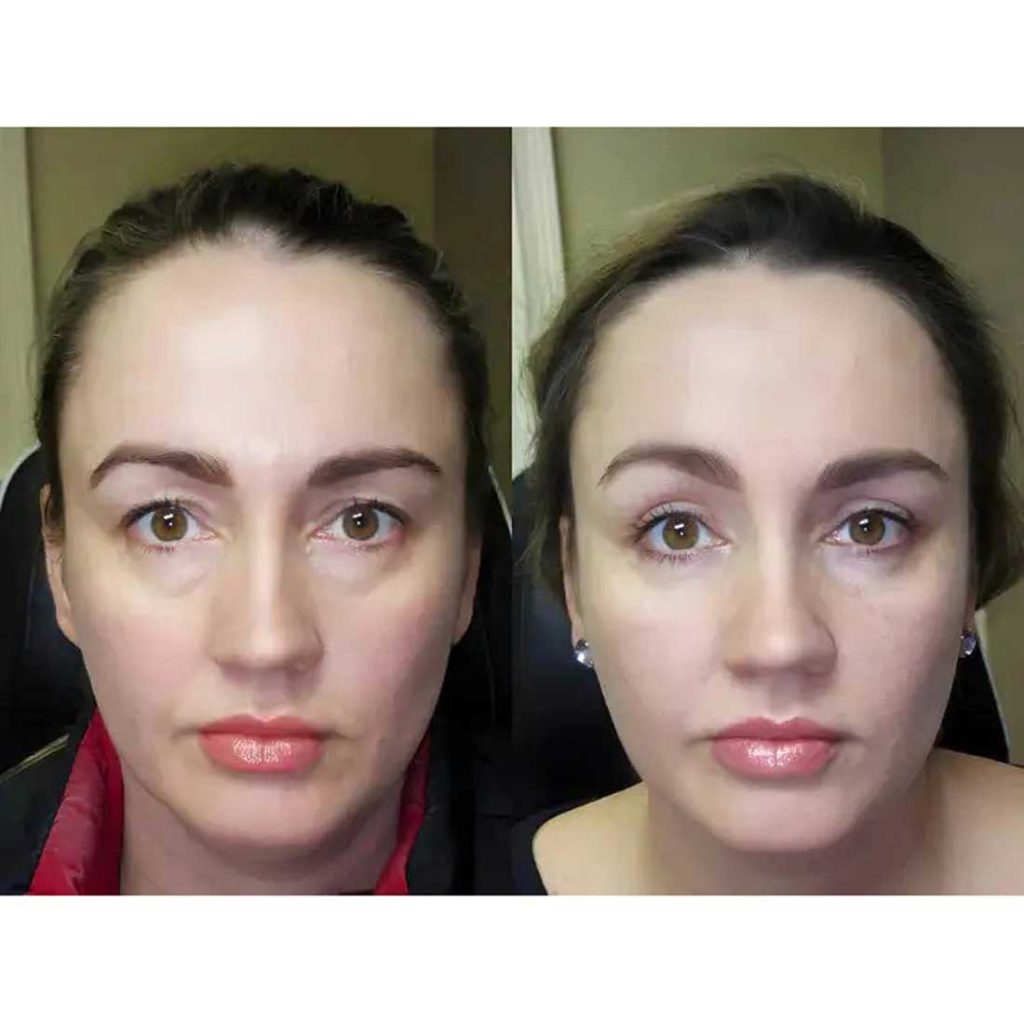 تاثیرات پد کلاژن جذبی آداد