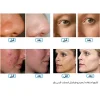 تاثیرات دستگاه هیدروفیشیال آیس بلو جوبی