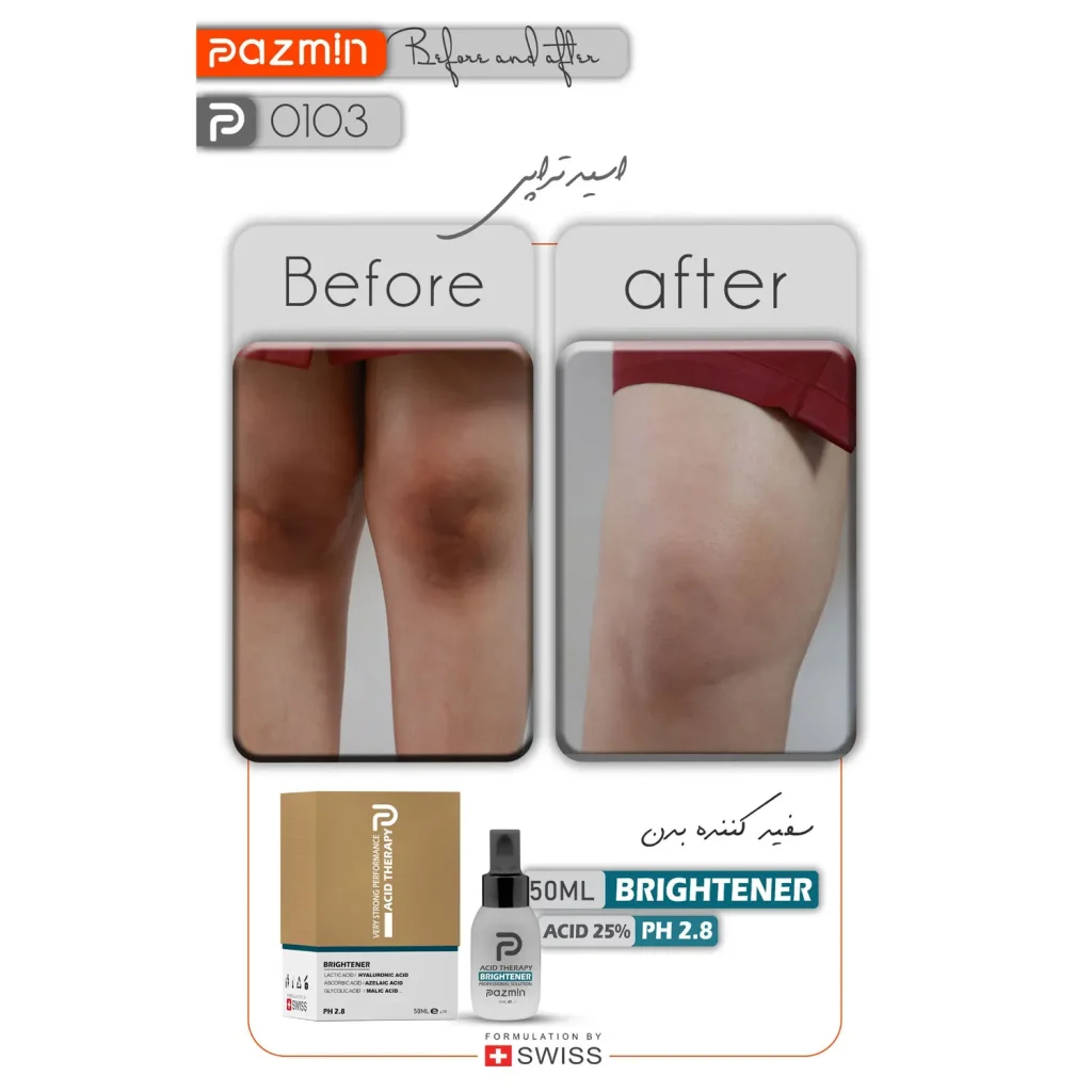 پیلینگ شیمیایی تخصصی ضدلک پازمین