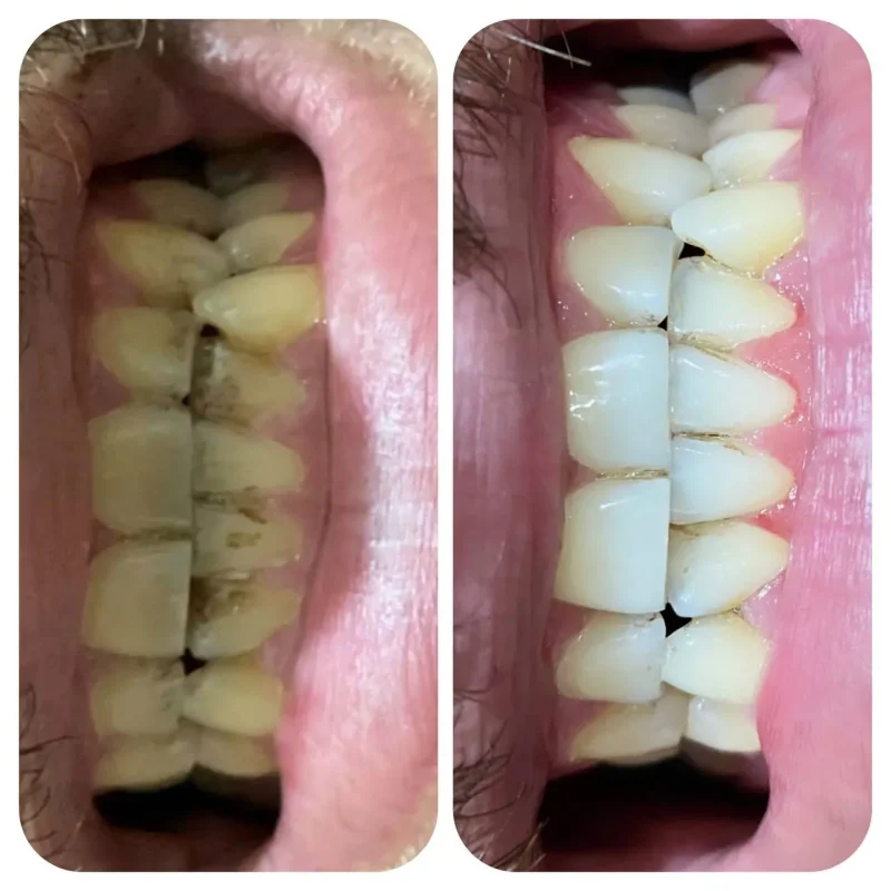 پودر جرمگیر و سفید کننده دندان اونیس