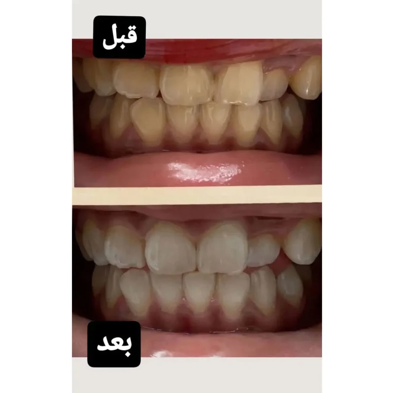 خمیر دندان سفیدکننده های اسمایل