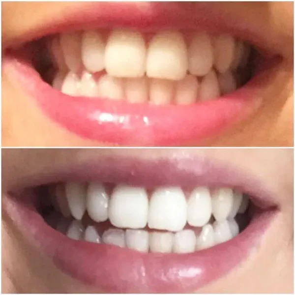 خمیر دندان سفیدکننده های اسمایل